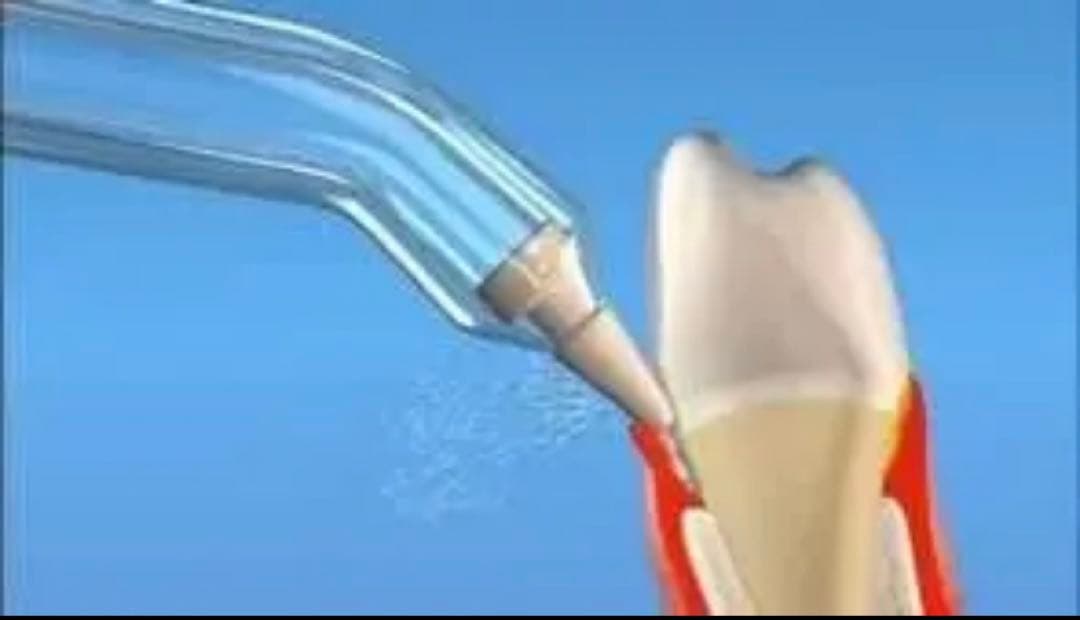 ウォーターフロッサー