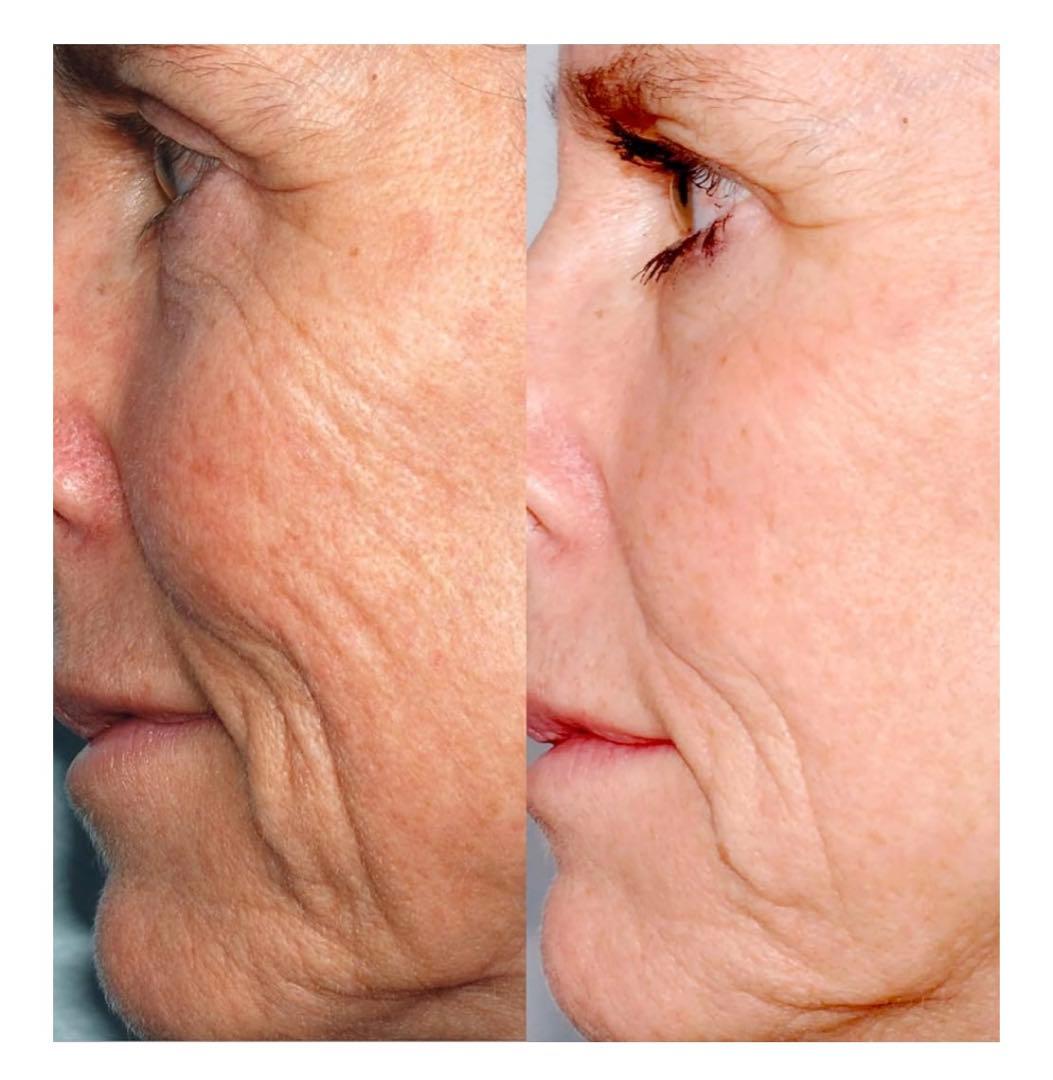 パーソナル・マイクロダーマ(PMD) 家庭用角質除去