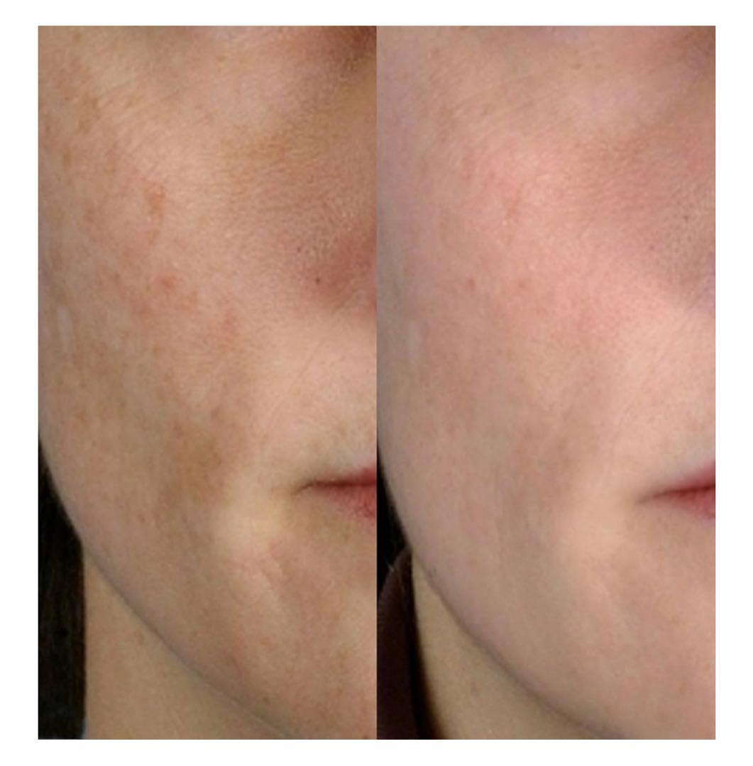 パーソナル・マイクロダーマ(PMD) 家庭用角質除去