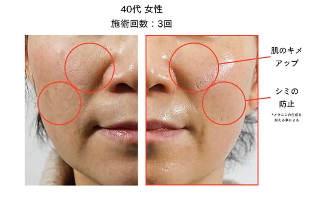 nami⭐︎新ララピール　2回分セット＋マスク2枚