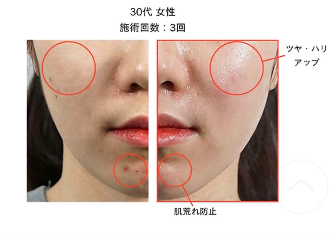 nami⭐︎新ララピール　2回分セット＋マスク2枚