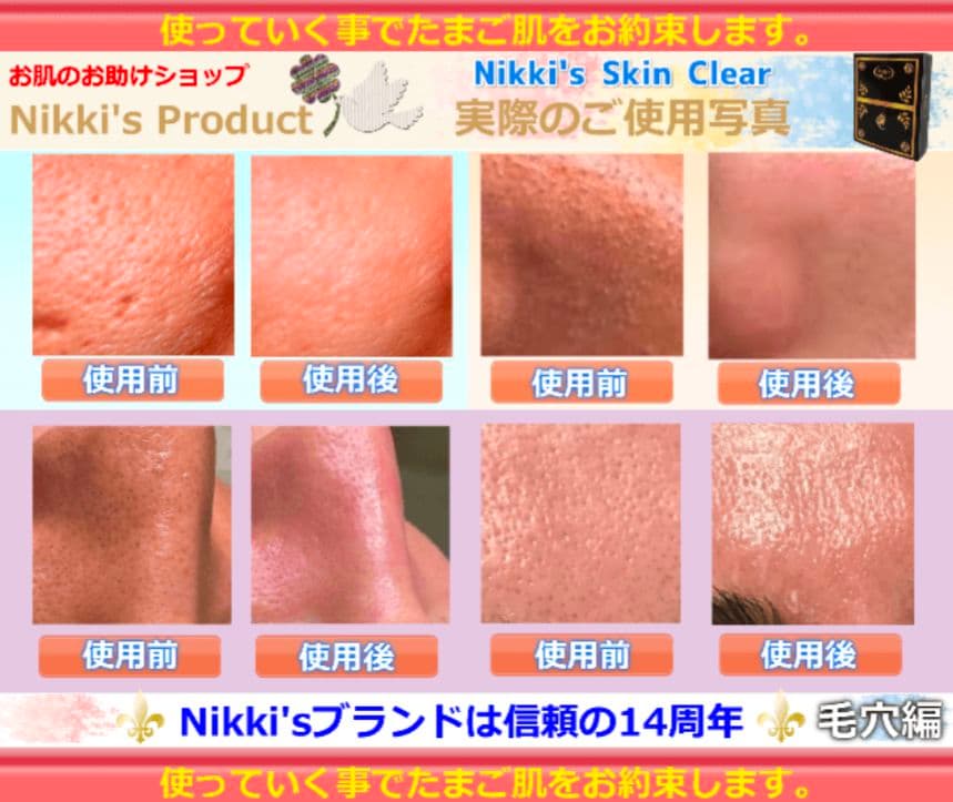 しみ、そばかす、ニキビ跡、毛穴　噂のNikki's Skin Clear　通常版
