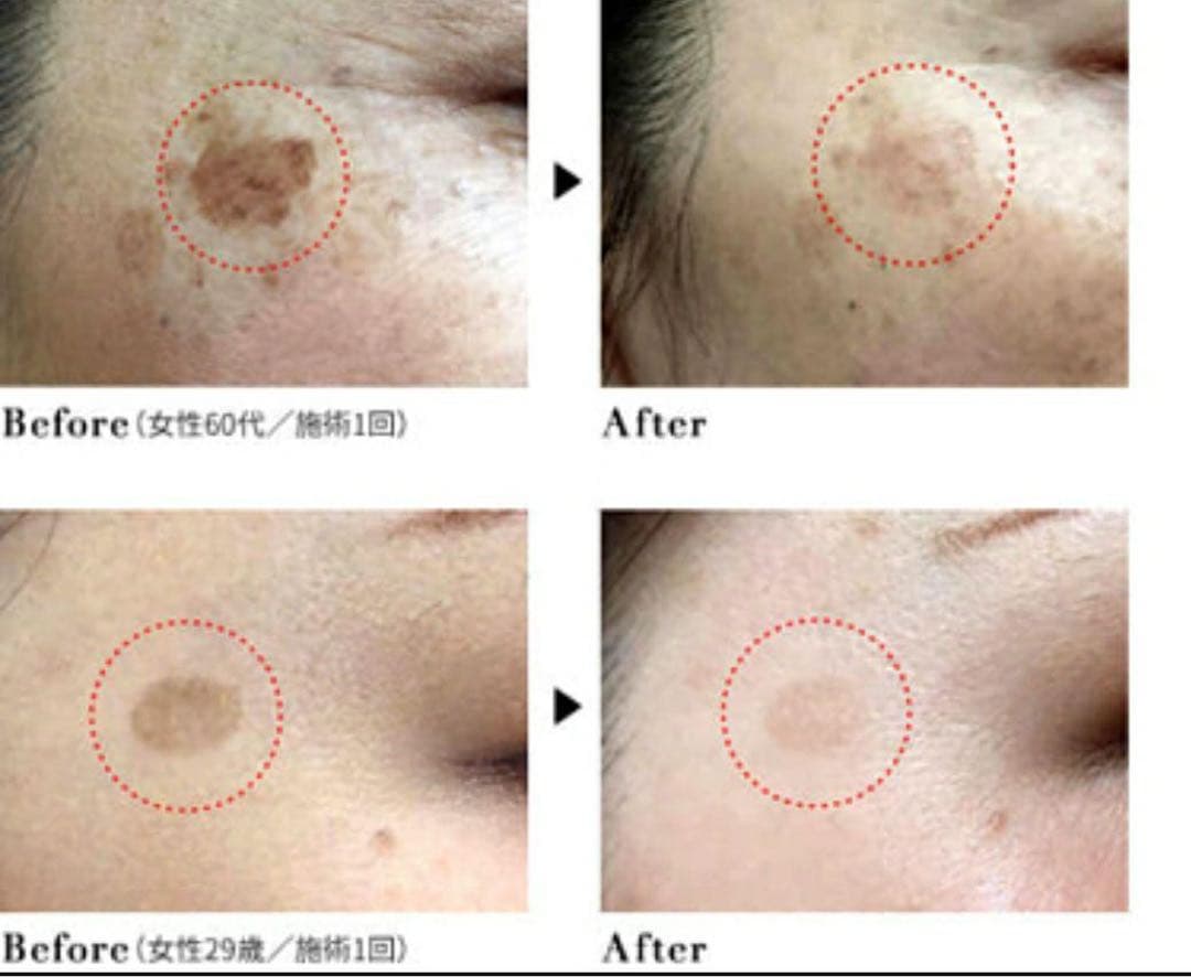 業務用美顔器　PIGNET OTHELLO The Skins Pro