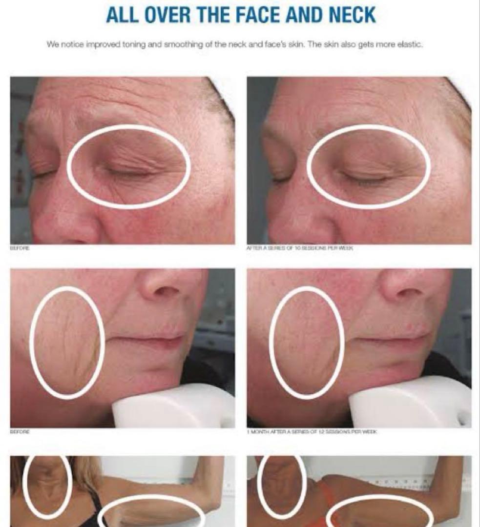 MPR トロイダル RF 業務用美容機器　美顔器　ダイエット　たるみ　しわ