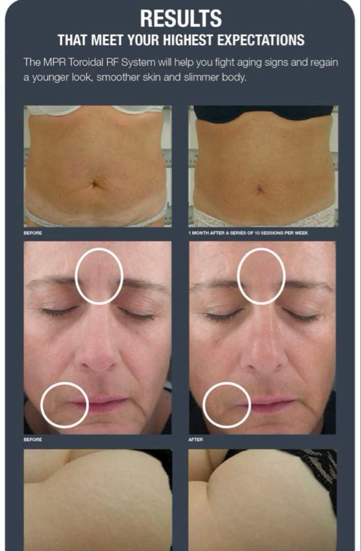 MPR トロイダル RF 業務用美容機器　美顔器　ダイエット　たるみ　しわ
