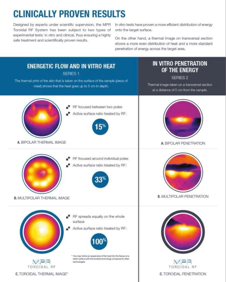 MPR トロイダル RF 業務用美容機器　美顔器　ダイエット　たるみ　しわ